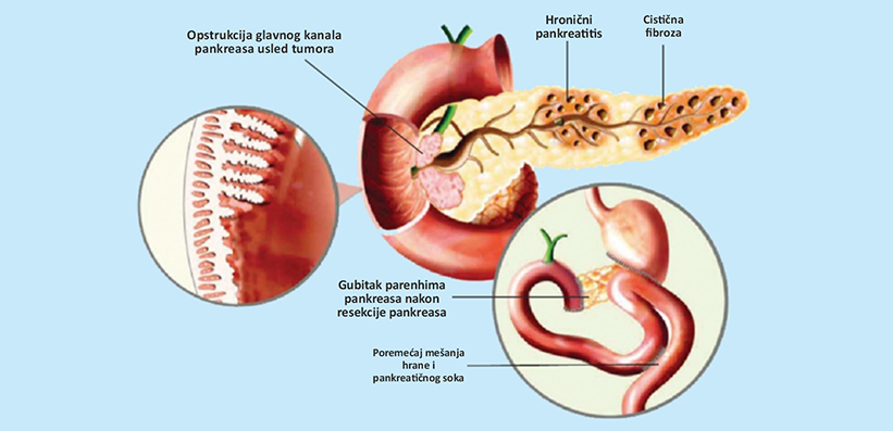 Uzroci nastanka egzokrine insuficijencije pankreasa